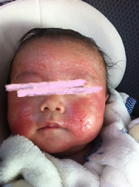 アトピー赤ちゃん生後3ヶ月の湿疹写真、画像