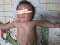 アトピー赤ちゃん生後4ヶ月の顔、体写真、画像