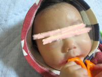 5ヶ月頃の赤ちゃんのアトピーの症状、写真画像