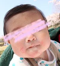 乳児生後７ヶ月アトピー改善の写真